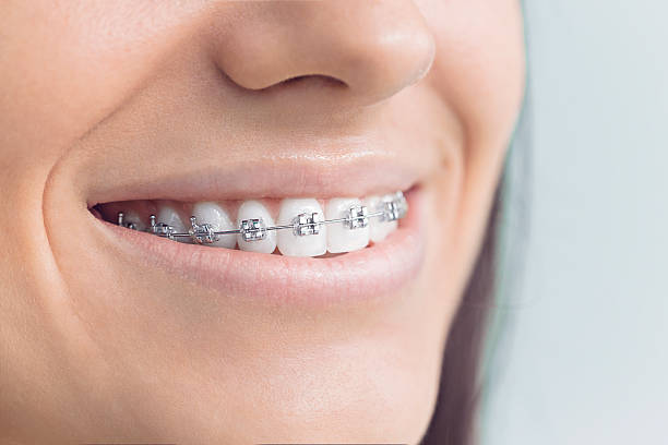 Best Traditional Braces  in Enetai, WA